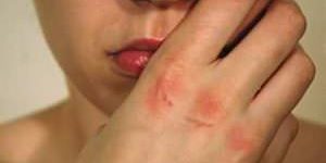 bulimia-signos